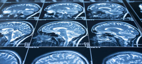 Mri brain scans of concussions in the workplace